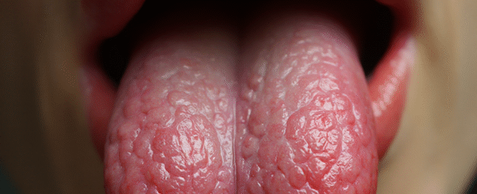 What's That Bump on Your Tongue? Causes Prevention Treatment