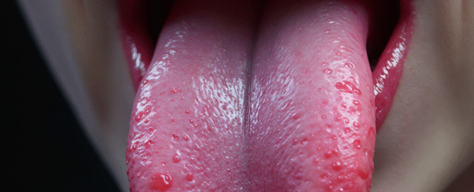What's That Bump on Your Tongue? Causes Prevention Treatment