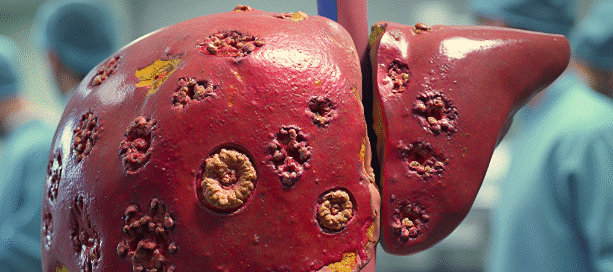 alcohol abuse most common cause of liver cancer